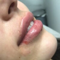 Aumento de labios relleno de labios cali