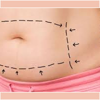 Abdominoplastia abdominoplastia cali