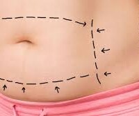 Abdominoplastia abdominoplastia cali