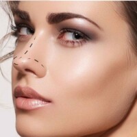 Rinoplastia rinoplastia cali
